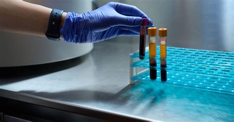 Early HIV White Blood Cell Count: Lab Test Results .